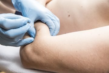 Trigger point therapy