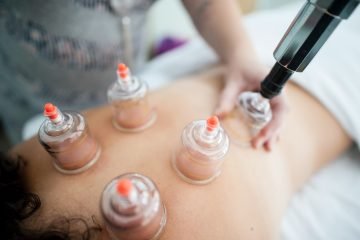 Θεραπεία Cupping